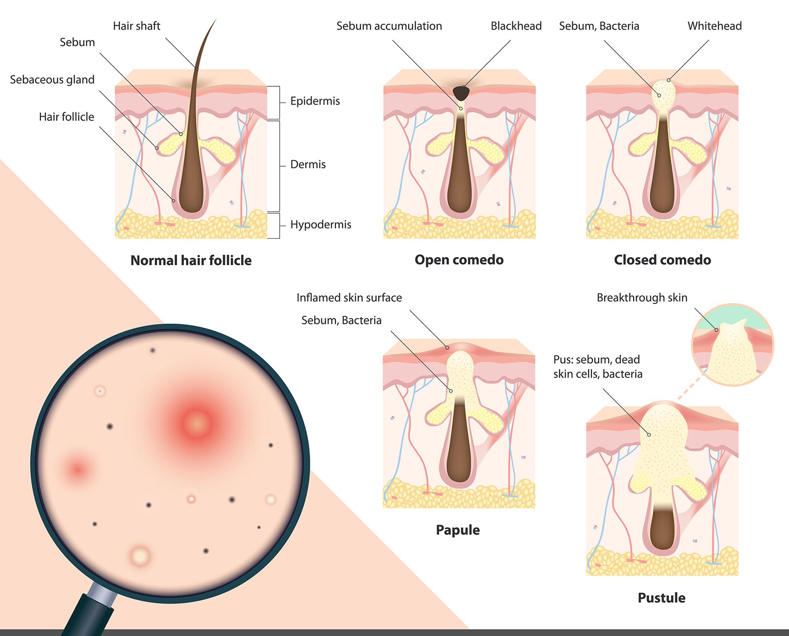 the different type of acne pimples and pustules